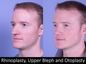 Rhino, bleph, otoplasty Raval 