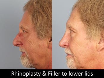 Rhinoplasty and filler