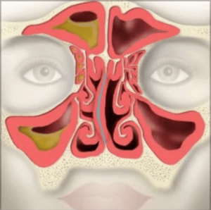 Nasal Valve Collapse