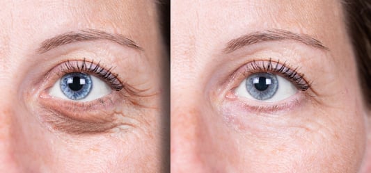 laser resurfacing under the eyes