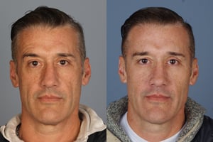 botoxmen Non-surgical procedures for men