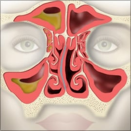 deviated septum sinus illustration