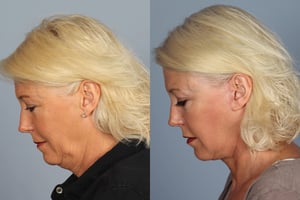 facelift recovery time