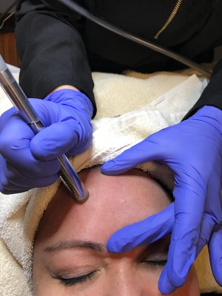 Microdermabrasion treatment