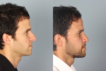 Rhinoplasty before and after profile