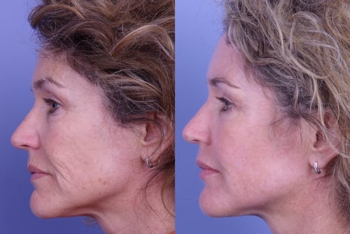 micro laser peel