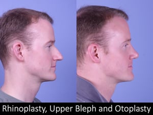 rhino, bleph, otoplasty Raval 3