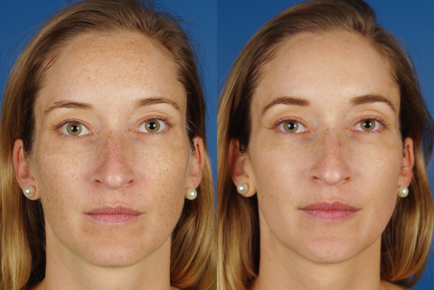 before and after example for laser skin treatments