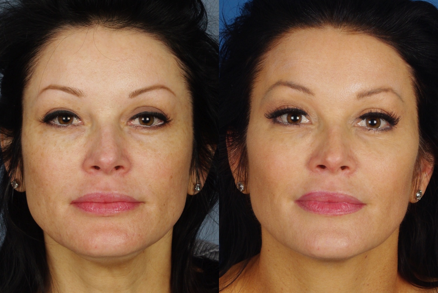 before and after example for laser skin treatments