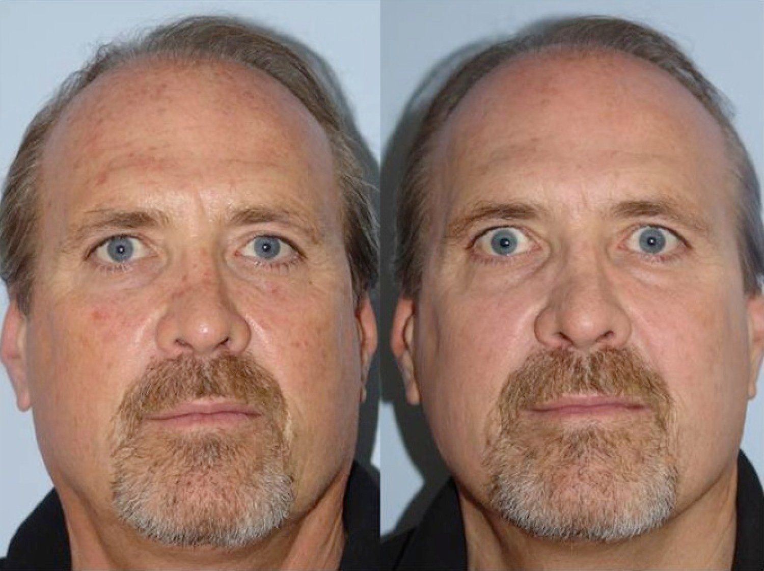 before and after example for laser skin treatments