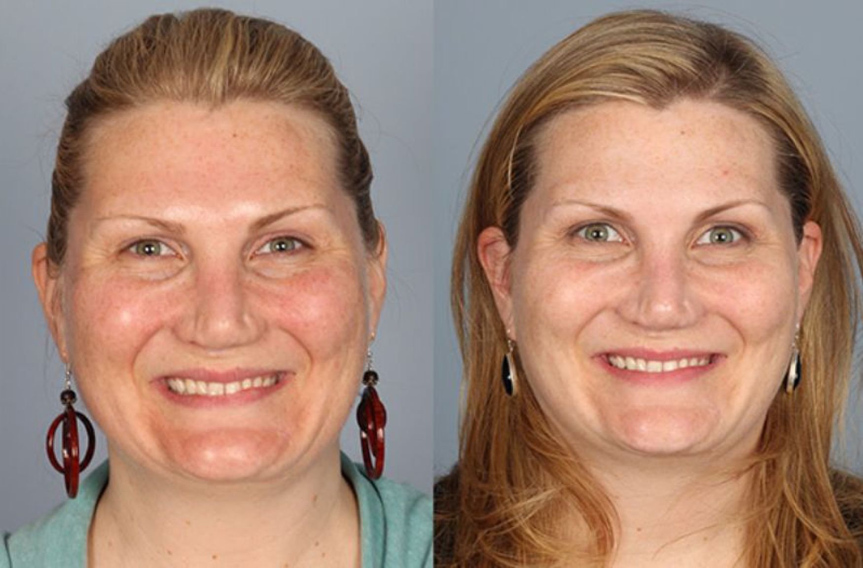 before and after example for laser skin treatments