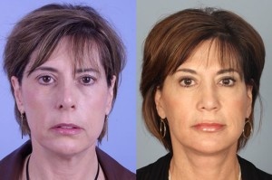 filler and botox