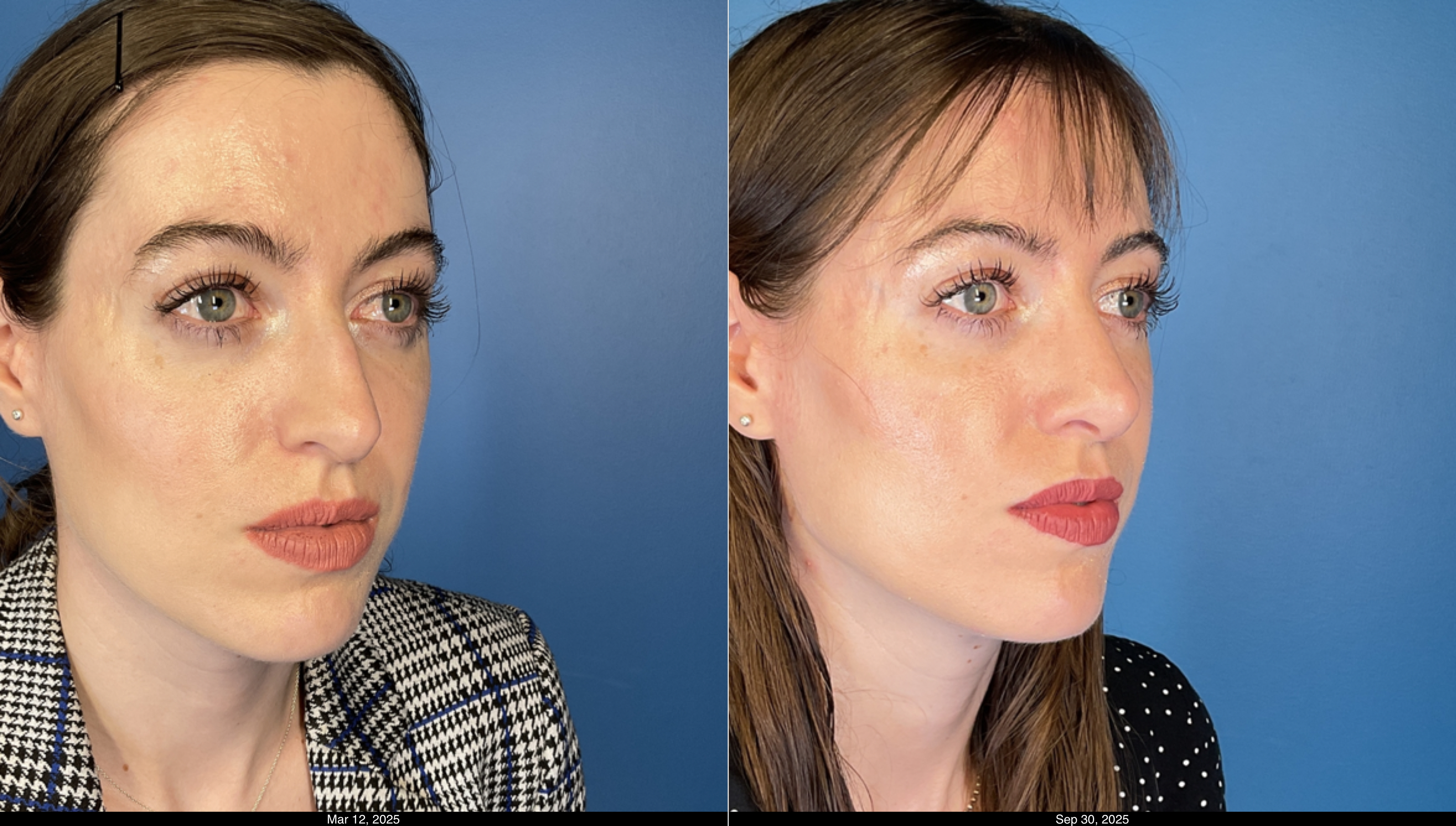 6 month rhinoplasty post op (3)