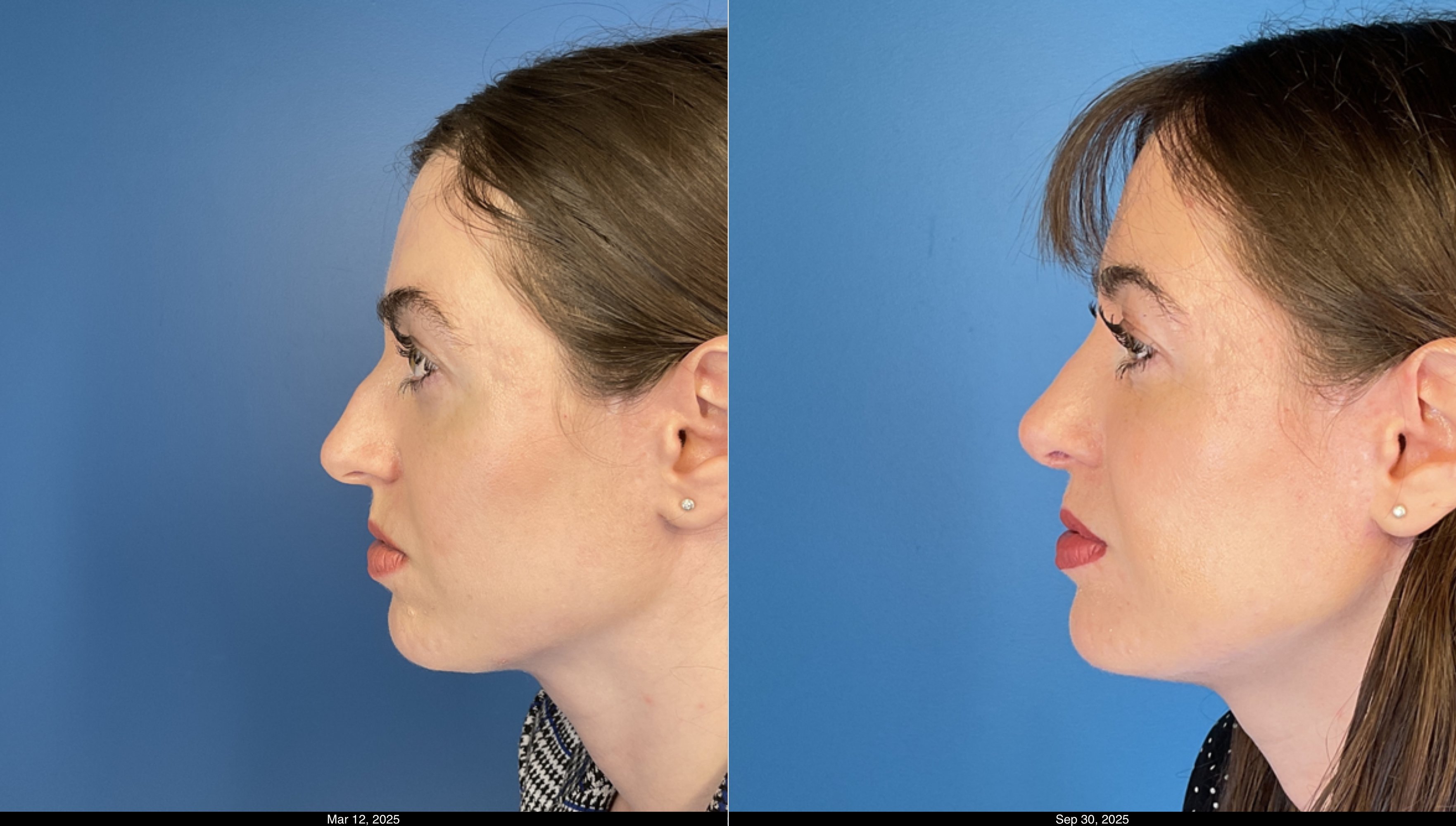 6 month rhinoplasty post op (4)