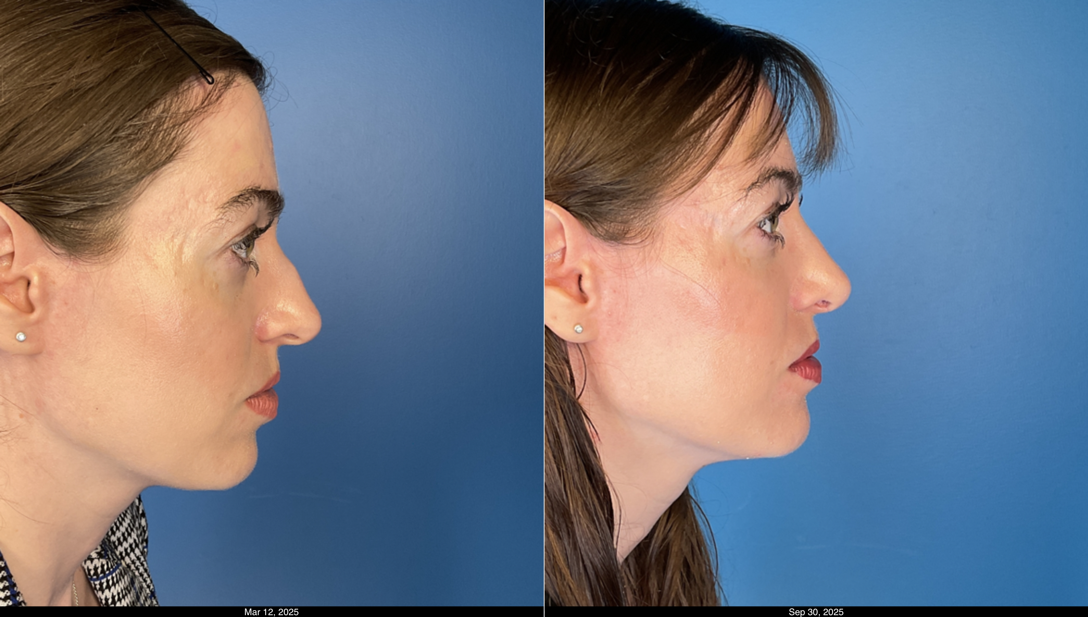 6 month rhinoplasty post op (5)