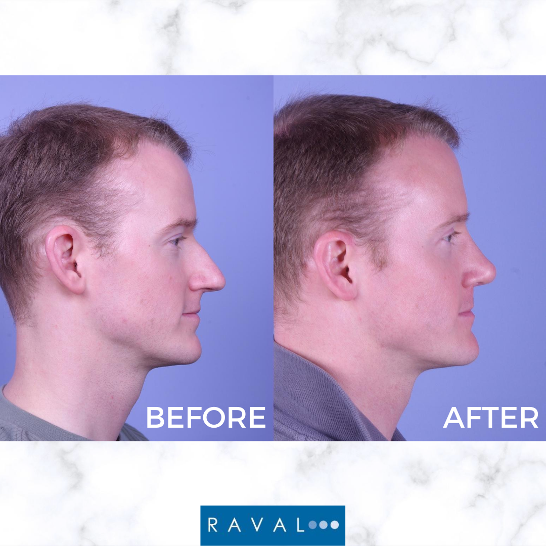 Unexpected Benefits of Rhinoplasty