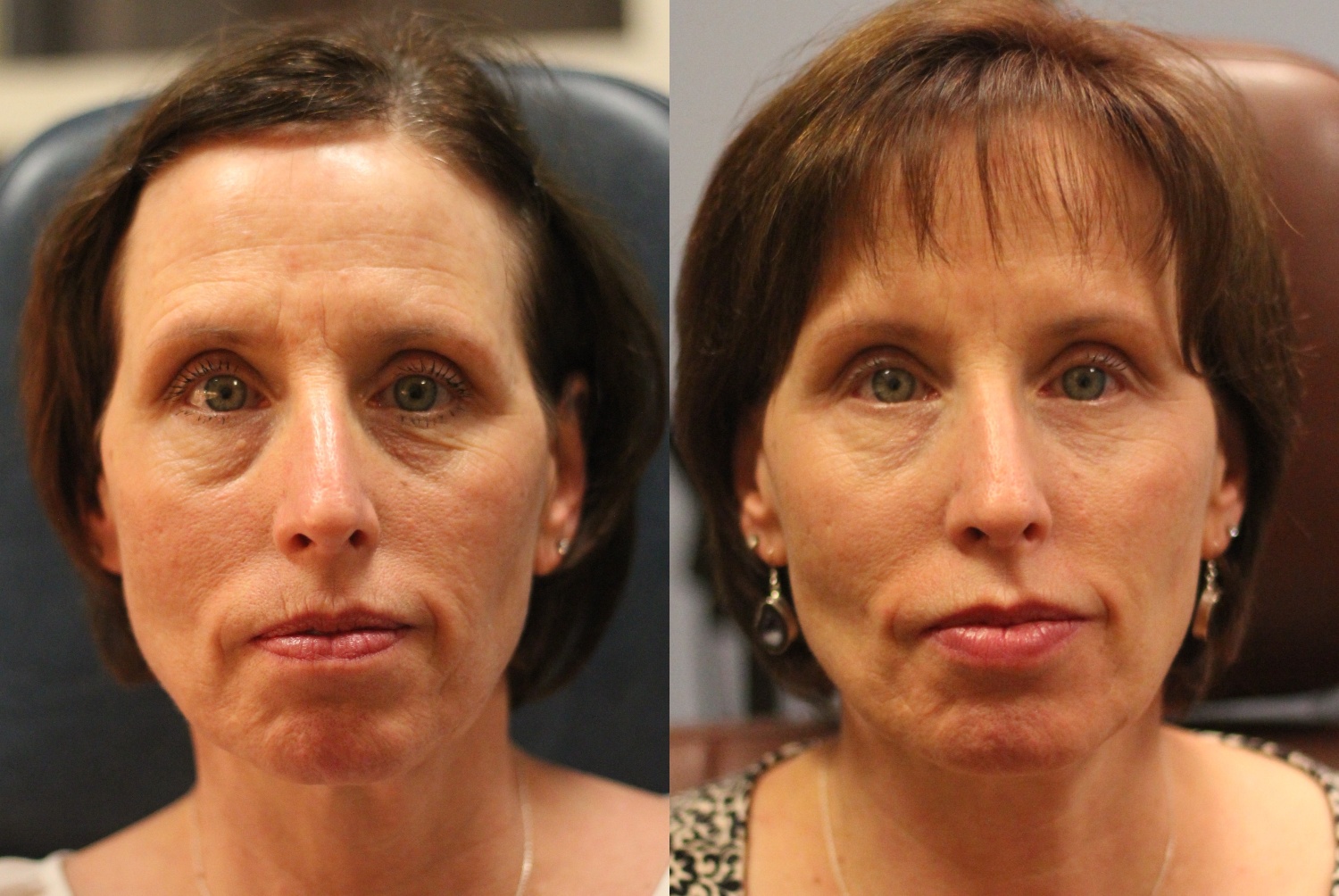 botox-filler-118-1 of 1