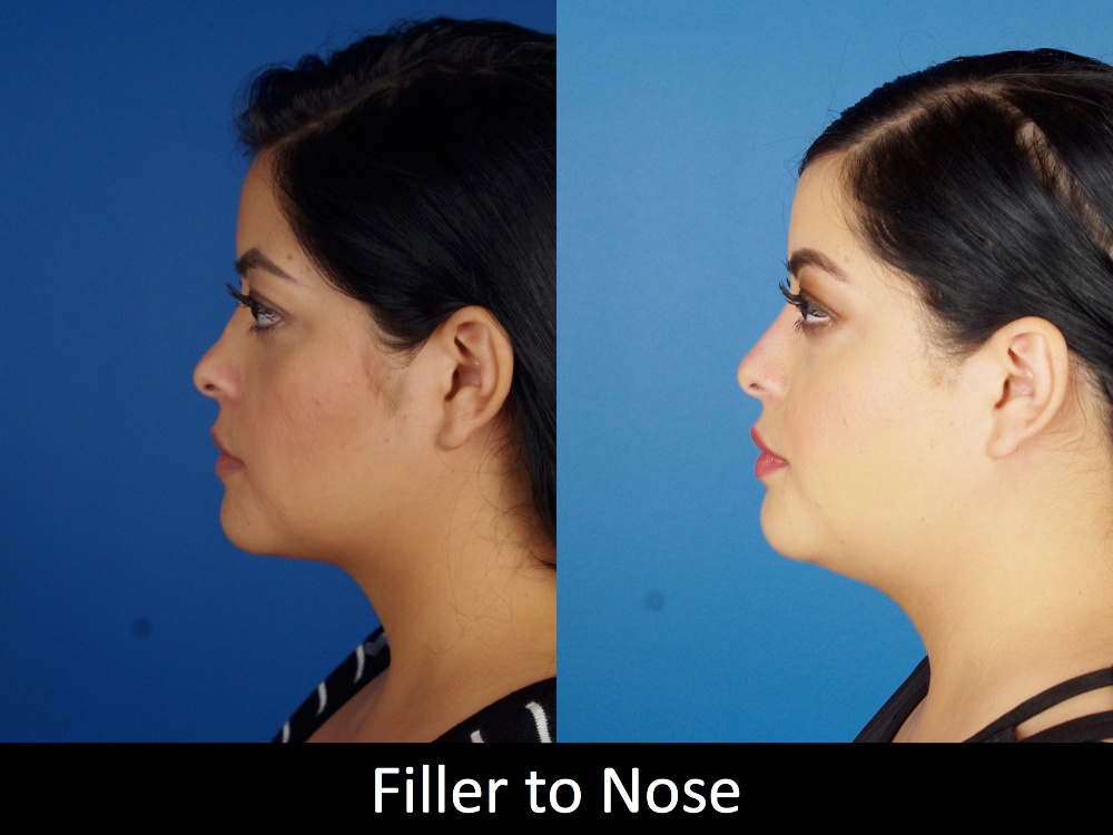 Botox-filler-125-2 of 3