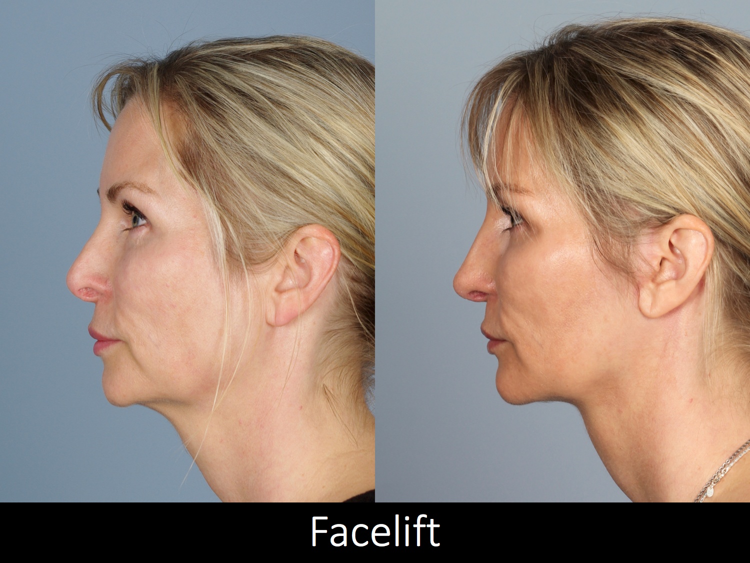 Facelift-008-2 of3