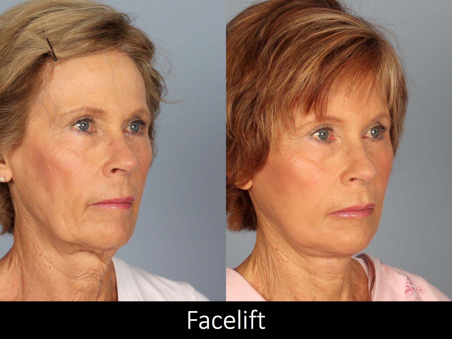 Facelift-009-2 of3