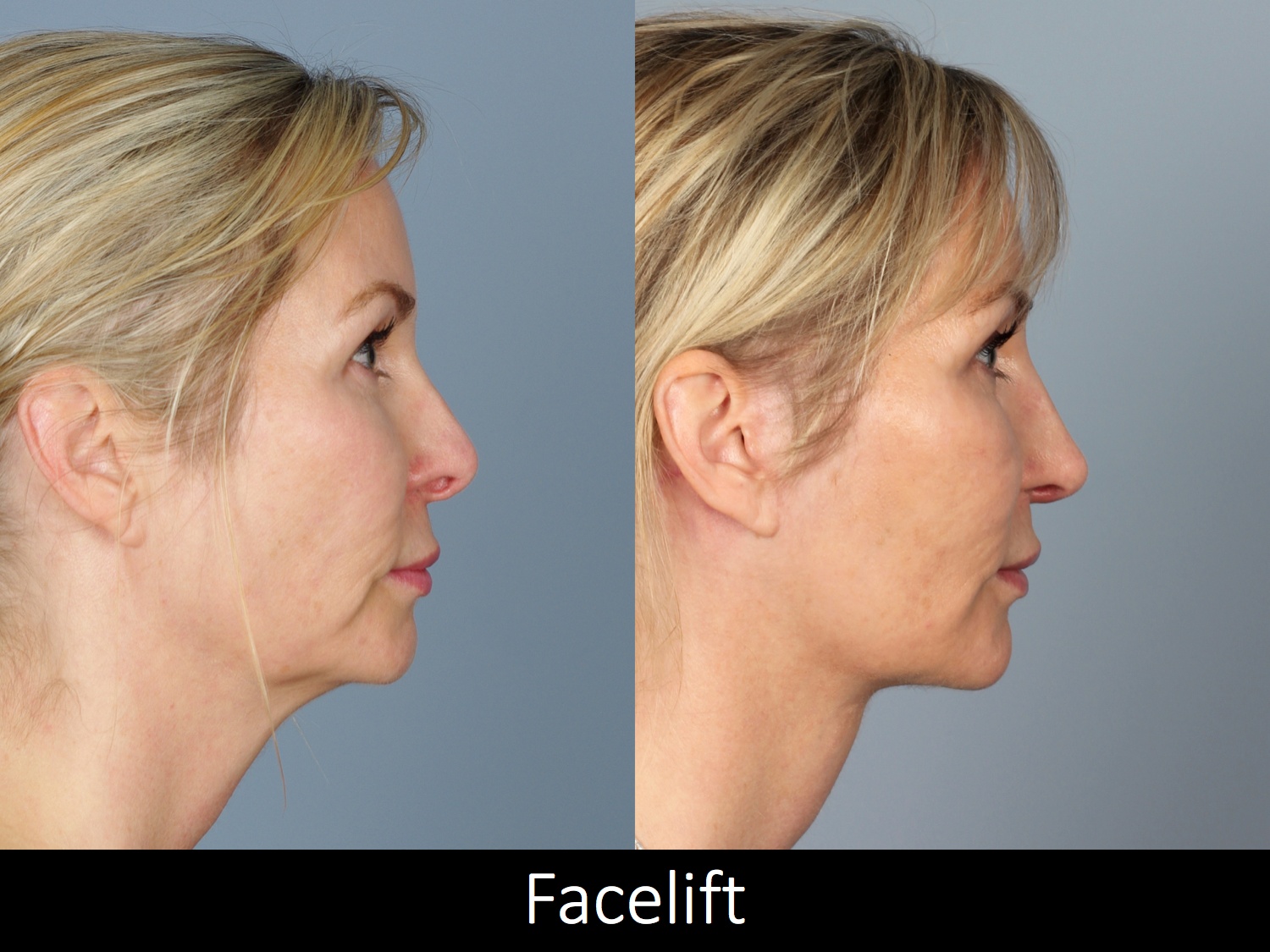 Facelift-008-3 of3