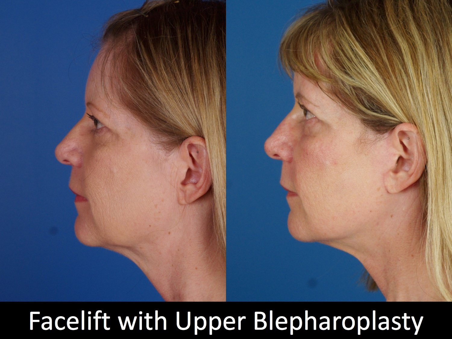 facelift-upper-bleph-110-4 of 4