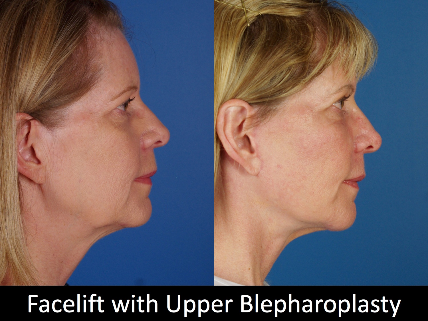 facelift-upper-bleph-110-3 of 4 