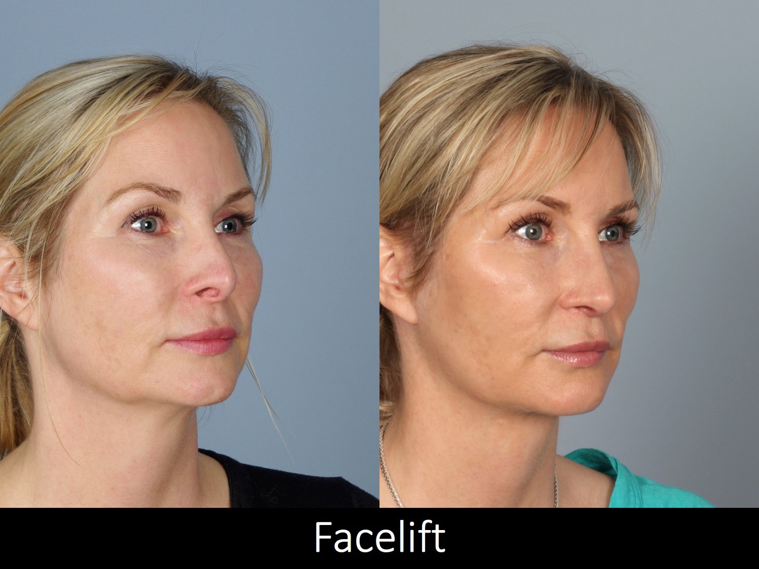 Facelift Before and After Photos