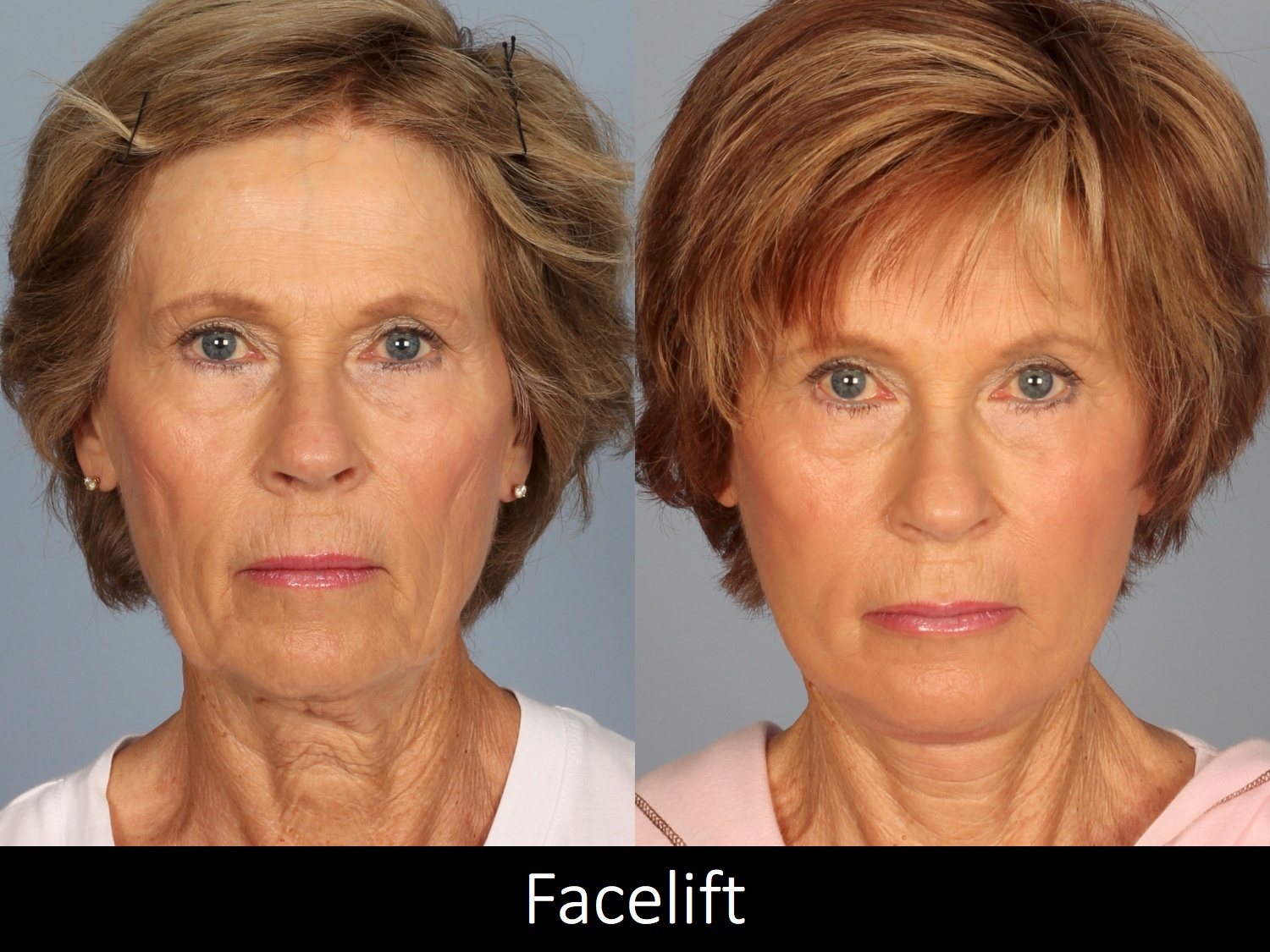 Facelift-010-1 of3