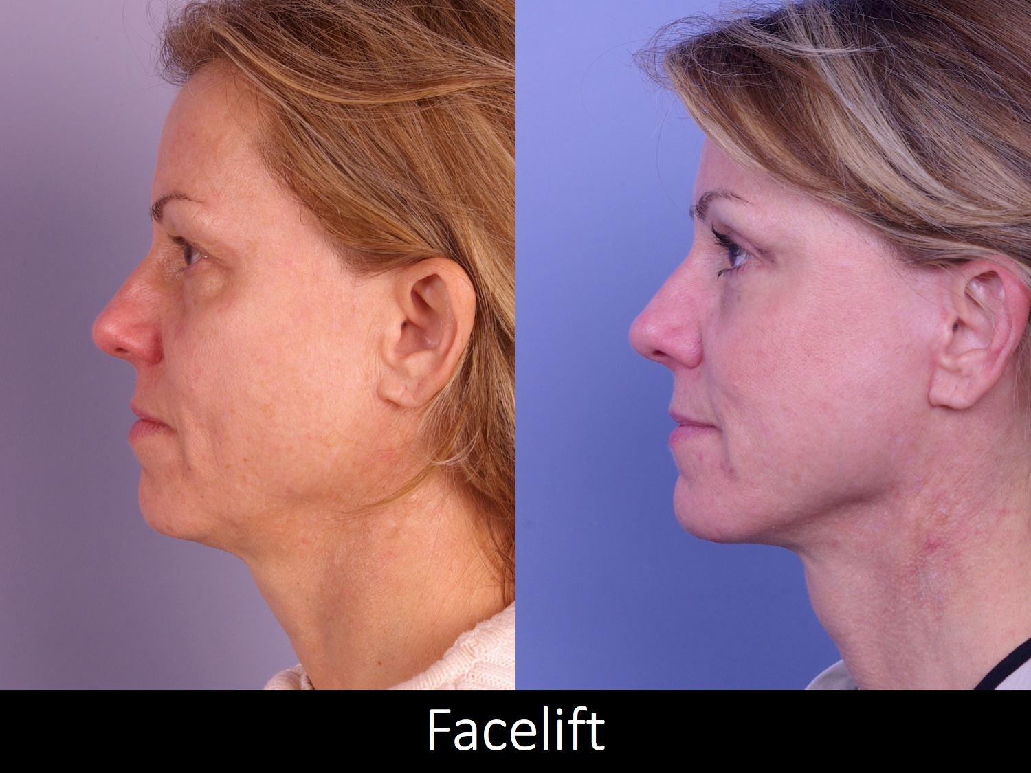 Facelift-009-1 of3