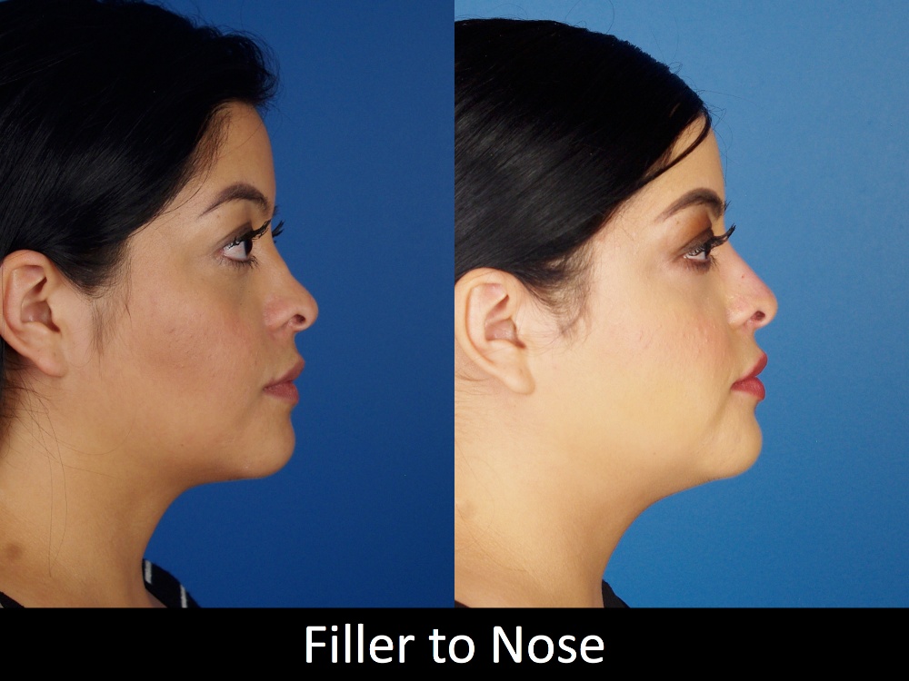 Botox-filler-125- 3 of 3