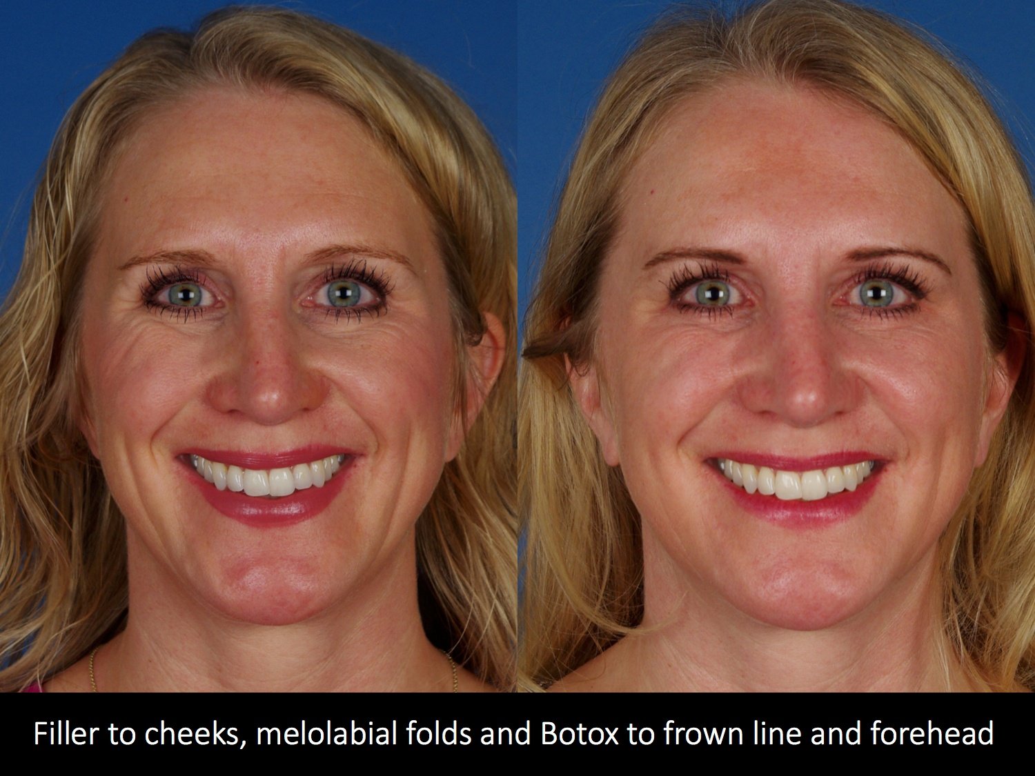 botox-filler-121-1 of 2