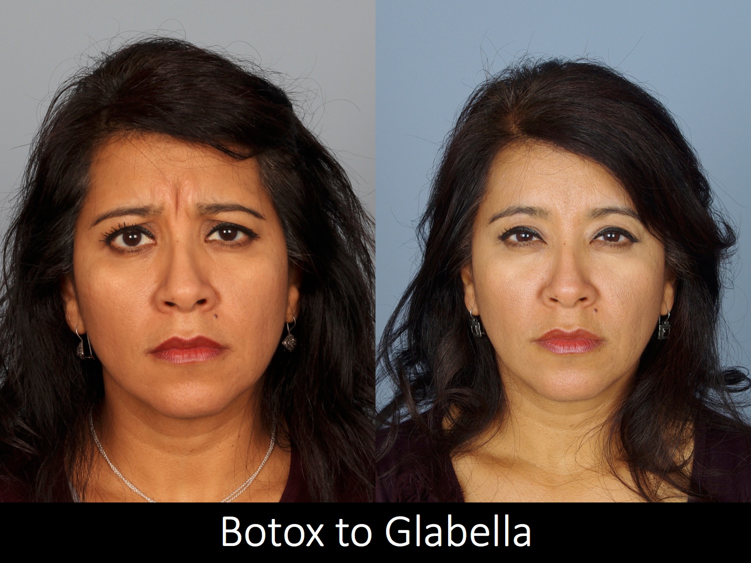 botox-filler-122-1 of 1