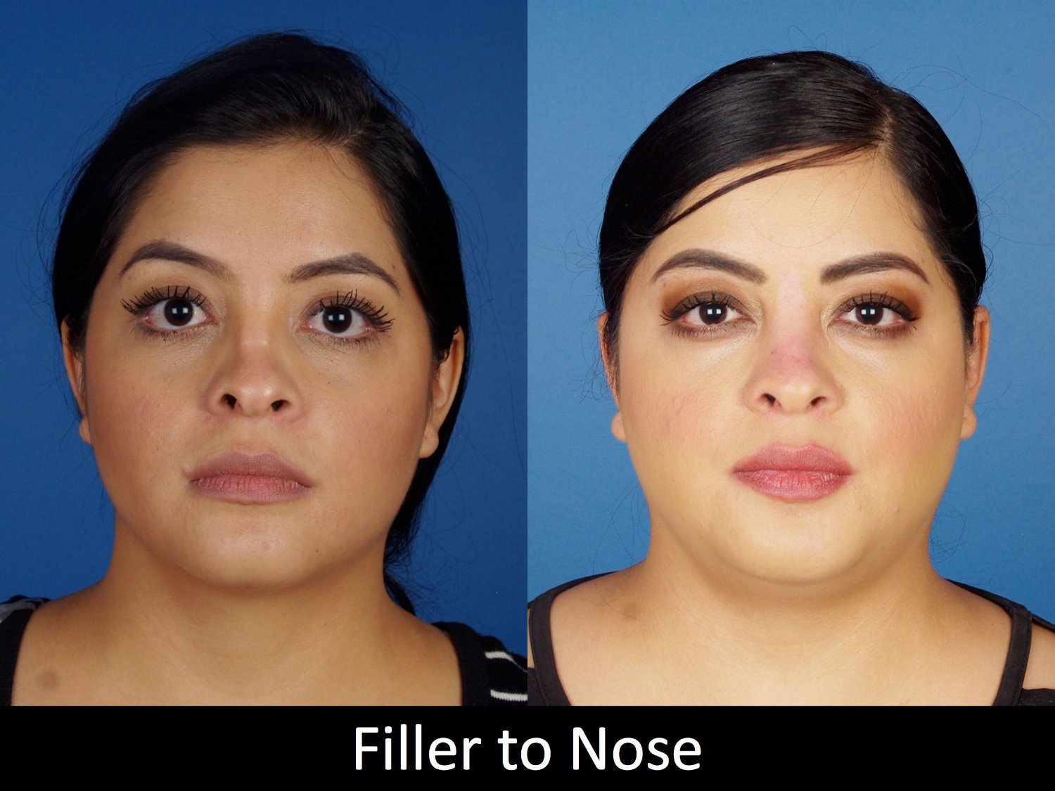 botox-filler-125-1 of 3