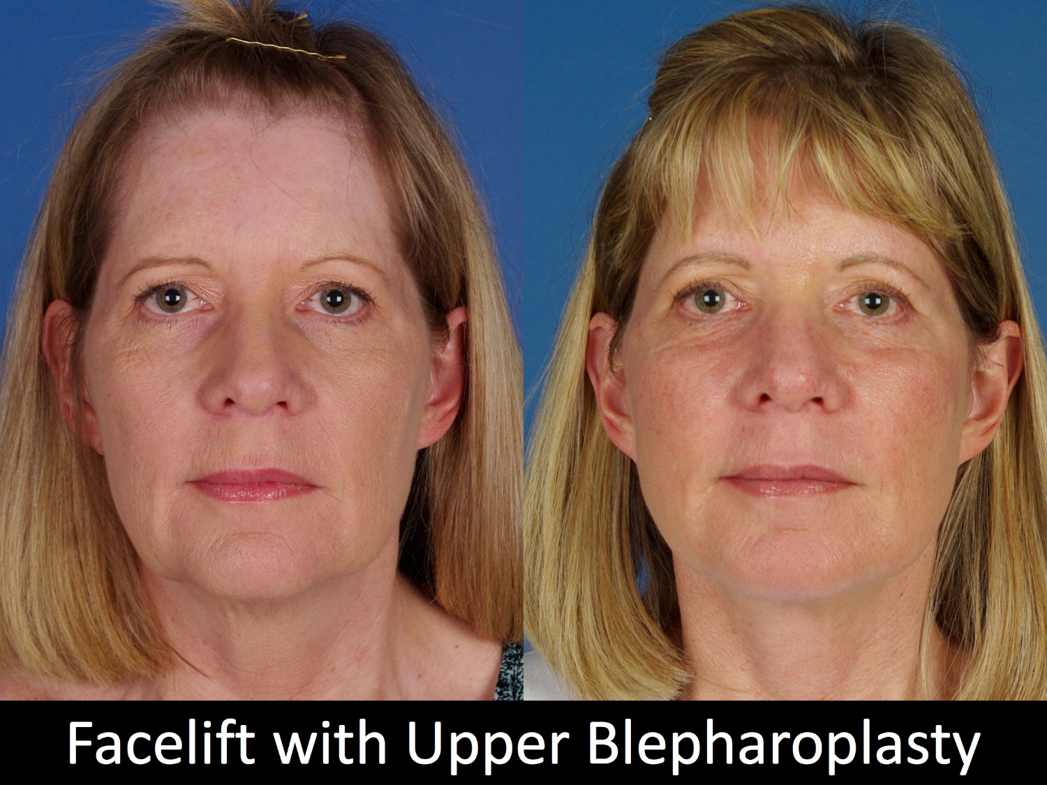 facelift-upper-bleph-110-1 of 4-1