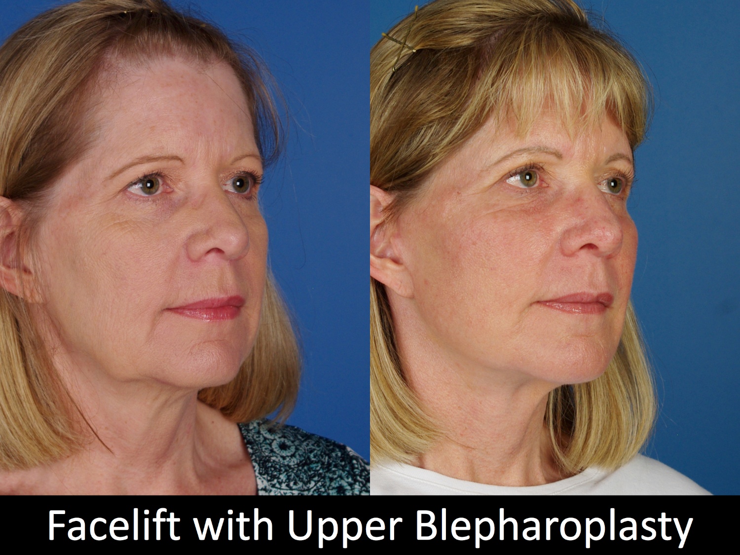 facelift-upper-bleph-110-2 of 4