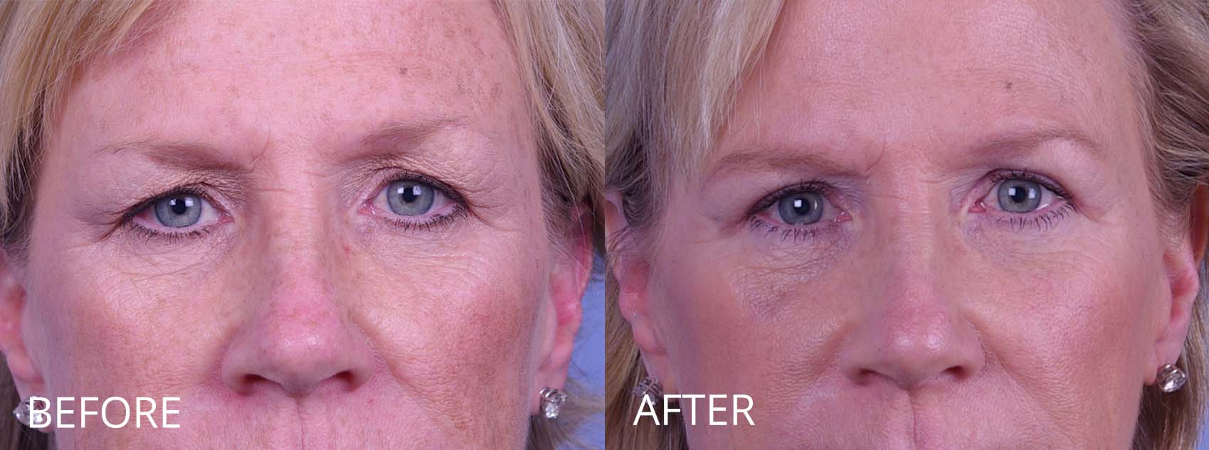 blepharoplasty-106-1