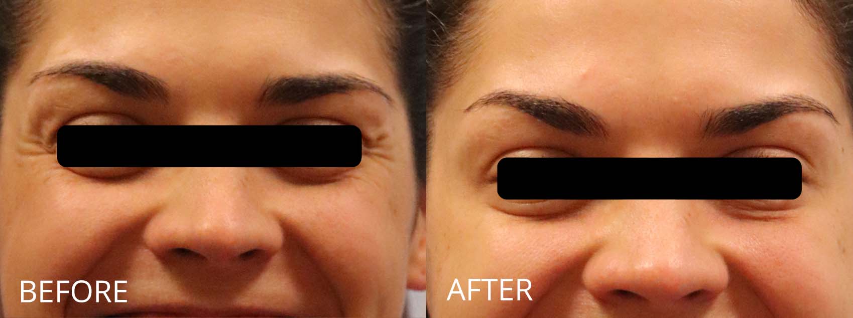 botox-filler-128-1