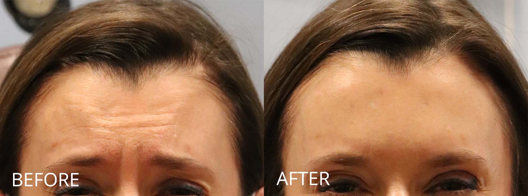 botox-filler-135-2