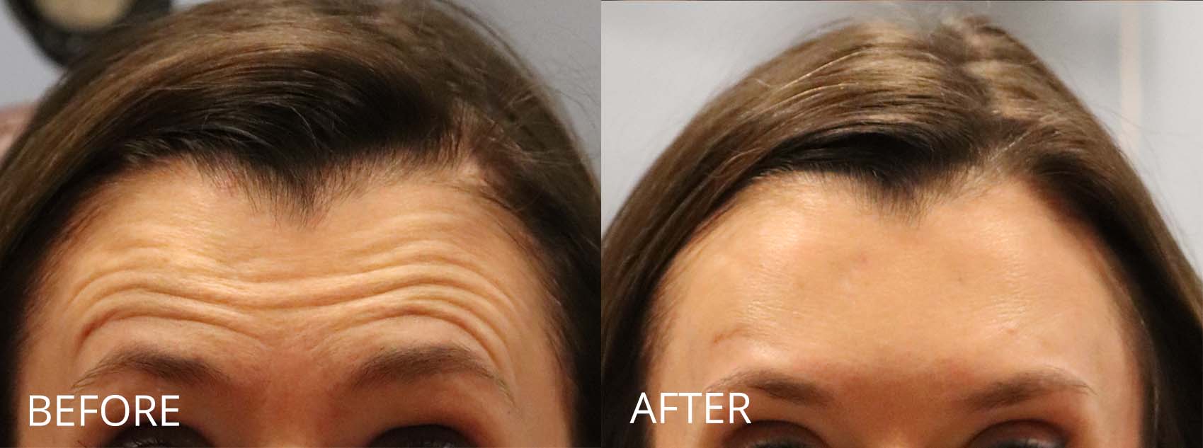 botox-filler-135-3