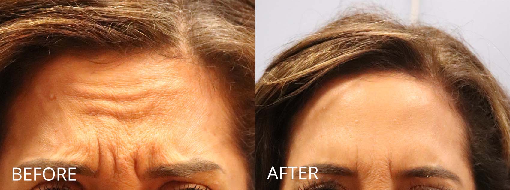 botox-filler-138-2