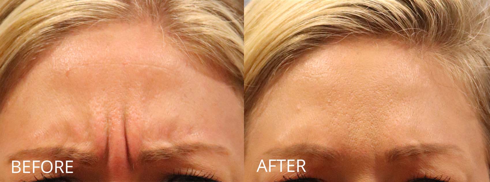 botox-filler-139-1