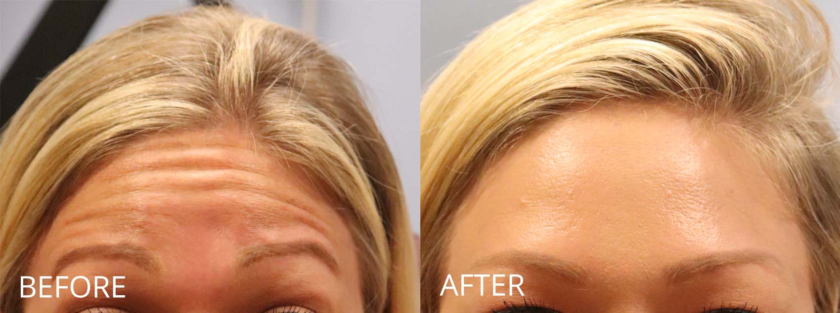 botox-filler-139-2