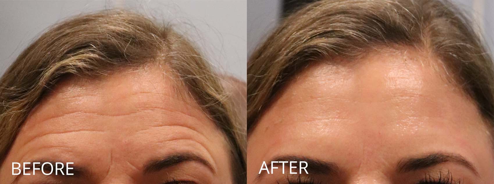 botox-filler-141-1