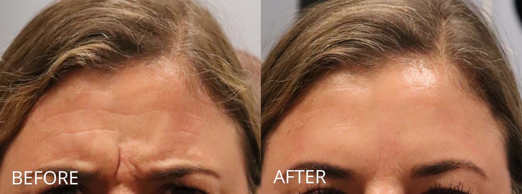 botox-filler-141-2