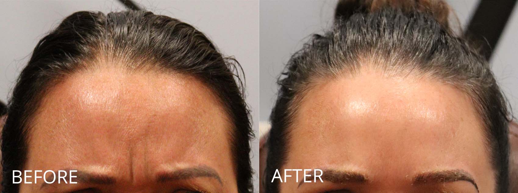 botox-filler-144-2