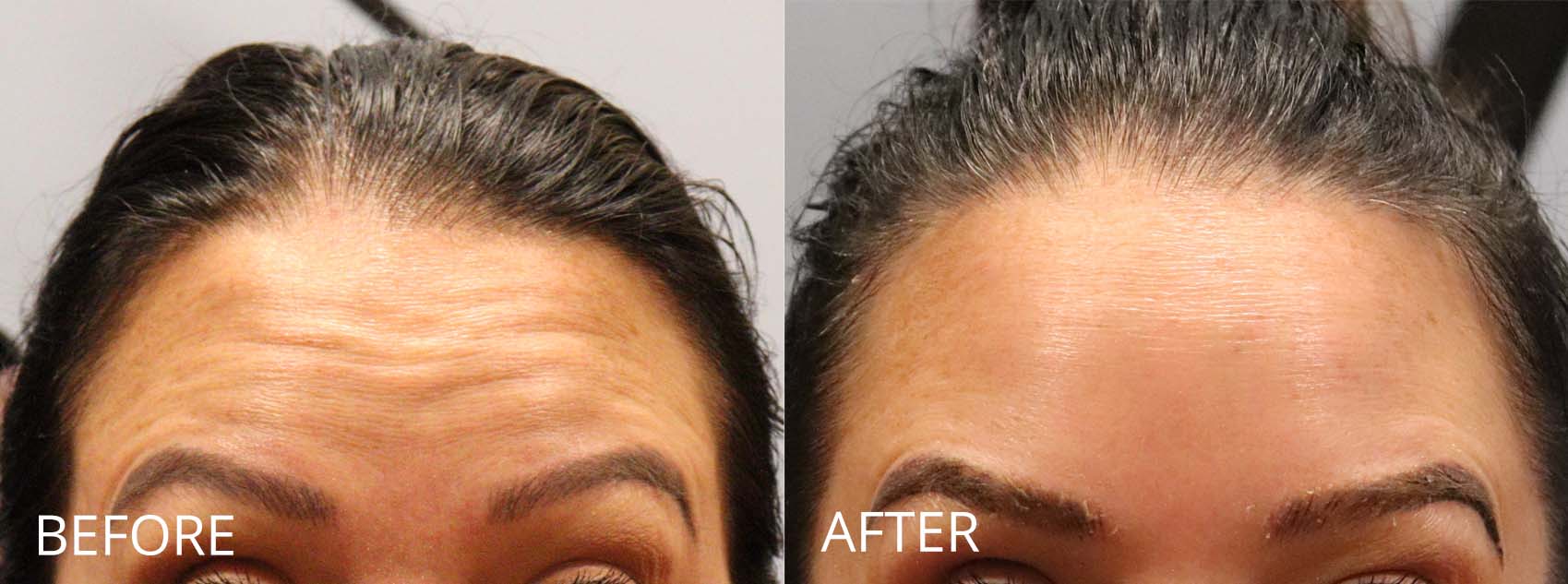 botox-filler-144-3