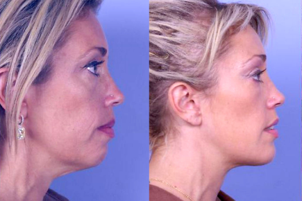 chin augmentation