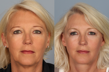 facelift & necklift