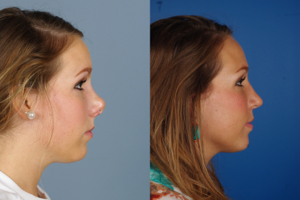 revision-rhinoplasty